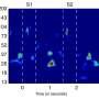 Bursts of beta rhythms implement cognitive control: Studying these bursts may improve understanding of cognition