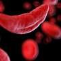 Researchers publish final results of key clinical trial for gene therapy for sickle cell disease