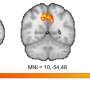 Stress activates brain regions linked to alcohol use disorder differently for women than men, finds study