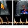 Study opens the door to designing therapies to improve lung development in growth-restricted fetuses