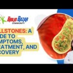 🪨 Demystifying Gallstones: Symptoms, Treatment, and Recovery Journey 🏥