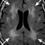 New study reveals age-related brain changes influence recovery after stroke