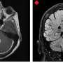 Form of B12 deficiency in cerebral spinal fluid found to negatively affect the central nervous system