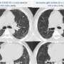 Lung complications can worsen two years after hospitalization for severe COVID-19