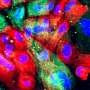 Protein NSD2 found to drive early prostate cancer development