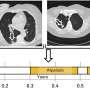 Researchers develop mechanism that predicts severity of aggressive form of breast cancer