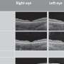 Treatment to preserve sight in children with rare genetic disorder shows promise in clinical trial